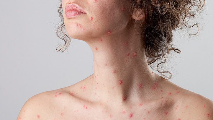 Chickenpox & How to Deal With It!